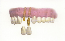 前歯のインプラント