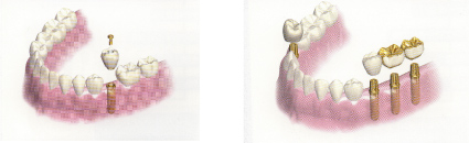 奥歯のインプラント